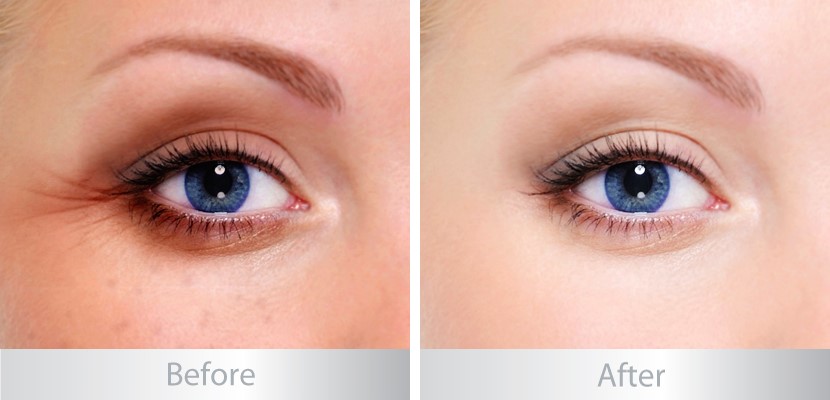 Gel dưỡng trị thâm quầng và bọng mắt EltaMD Renew Eye Gel 15ml bán chạy số 1 tại Hoa Kỳ-hibeauty